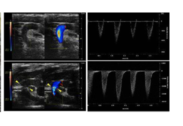 心血管系統模型之主動脈弓縮窄模型